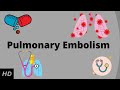 Pulmonary Embolism Causes Signs And Symptoms Diagnosis And Treatment