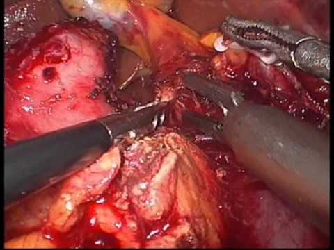 Laparoscopic Pancreaticoduodenectomy