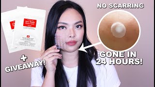 HOW PIMPLE PATCHES WORK TO GET RID OF PIMPLES OVERNIGHT!
