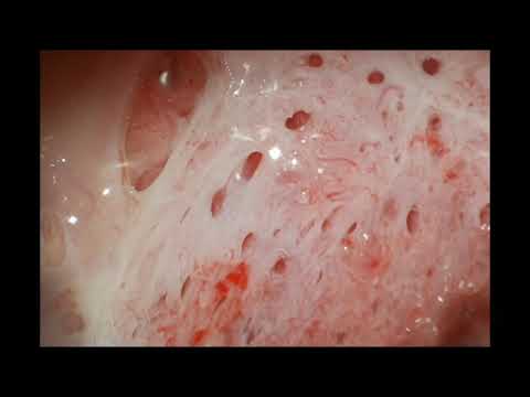 Pathology behind Constant Watery Vaginal Discharge | CMAR