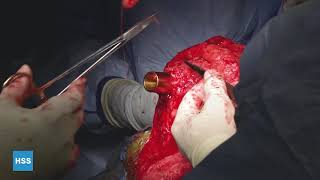Dr. Rozbruch performs live Osseointegration Femur Surgery