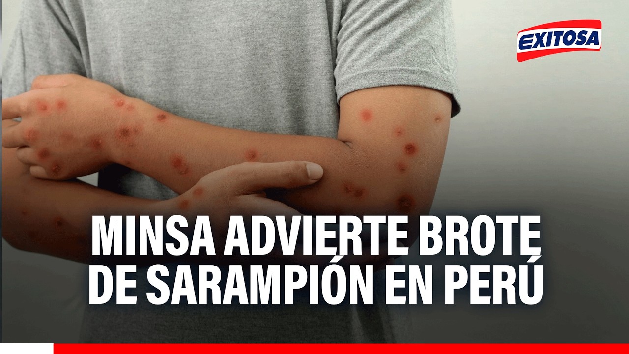 🔴🔵 Alerta por brote de sarampión en el Perú: Hay un 60% de casos en personas entre los 18 y 25 años