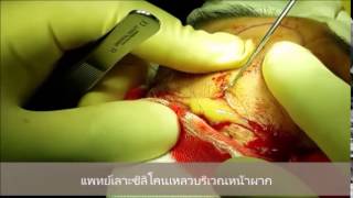 เลาะซิลิโคนเหลวที่หน้าผาก