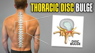 Thoracic Disc Bulge and Herniation Exercises