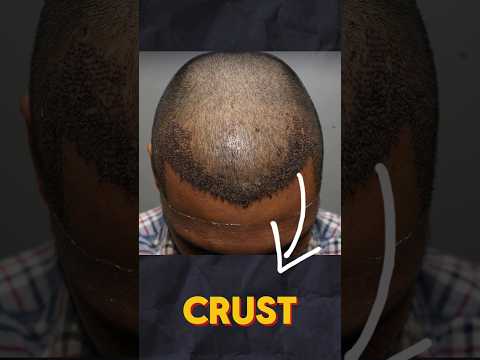 When to Remove Crust After Hair Transplant?  | Learn from the hair transplant surgeon | Dr Jangid