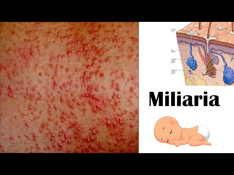 Miliaria (Heat Rash) - Types, Causes, Signs & Symptoms & Treatment