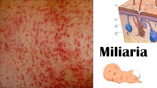 Miliaria (Heat Rash) - Types, Causes, Signs & Symptoms & Treatment