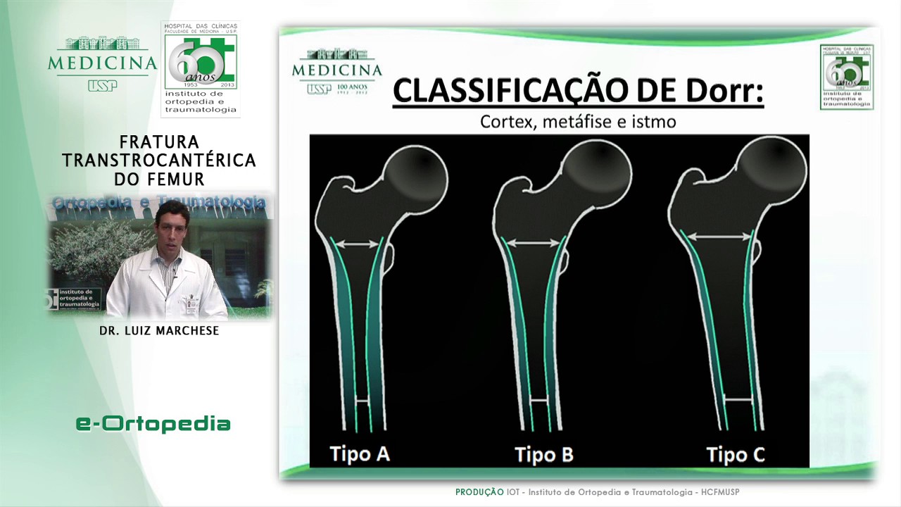 Fratura Transtrocantérica do Femur - Dr. Luiz Marchese