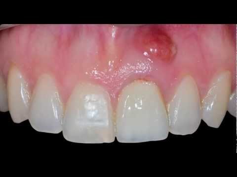 Dental Implant in the Aesthetic Zone