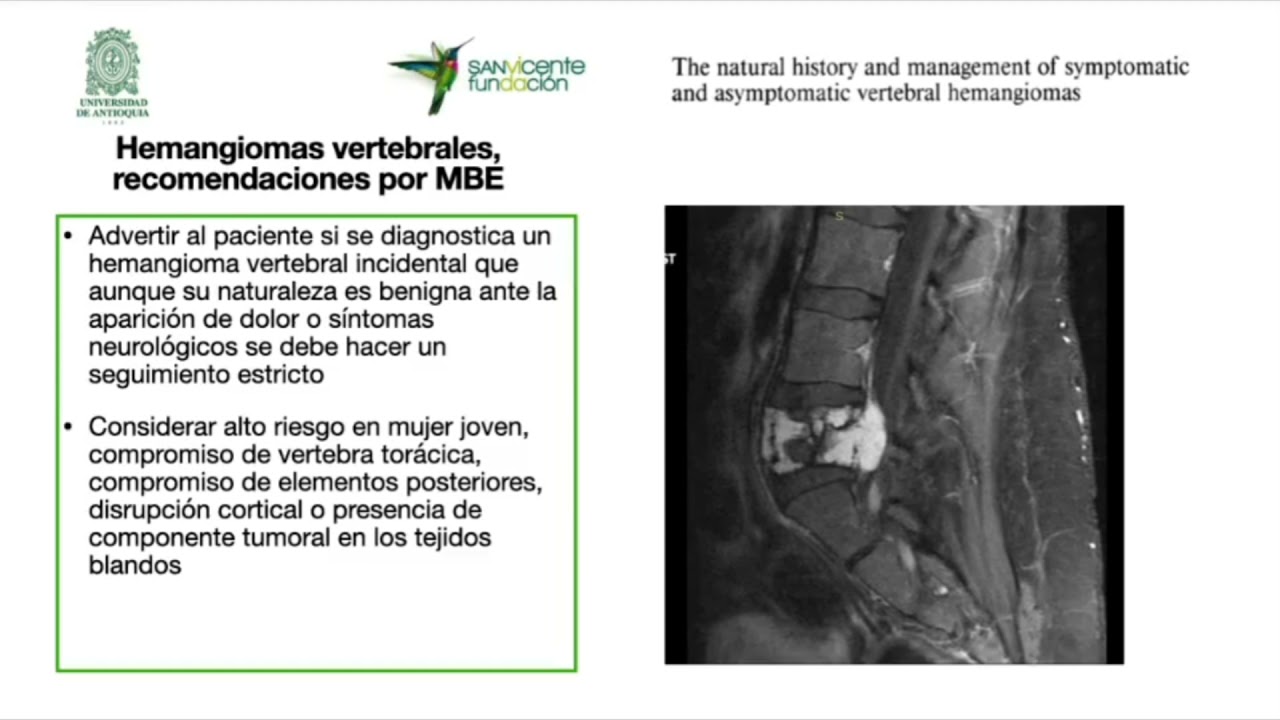 Hemangiomas Vertebrales. Dr Eloy Barrios.
