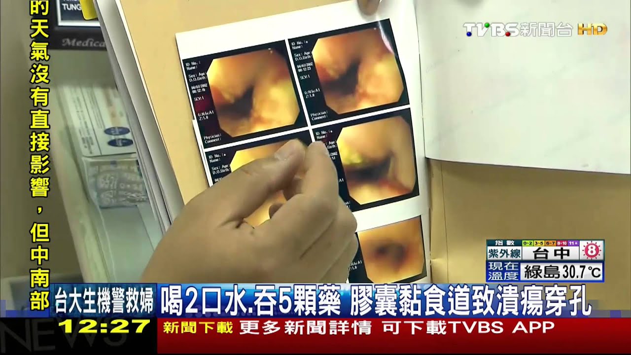喝2口水、吞一包藥 膠囊黏食道致潰瘍穿孔