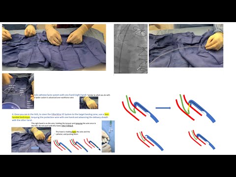 Vein graft PCI: Focus on distal embolic protection-how, when, pitfalls, troubleshooting- Elias Hanna