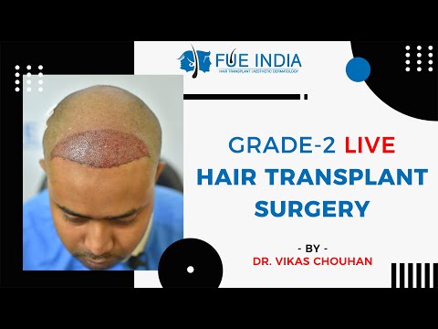 Hair Transplant Result Video 2