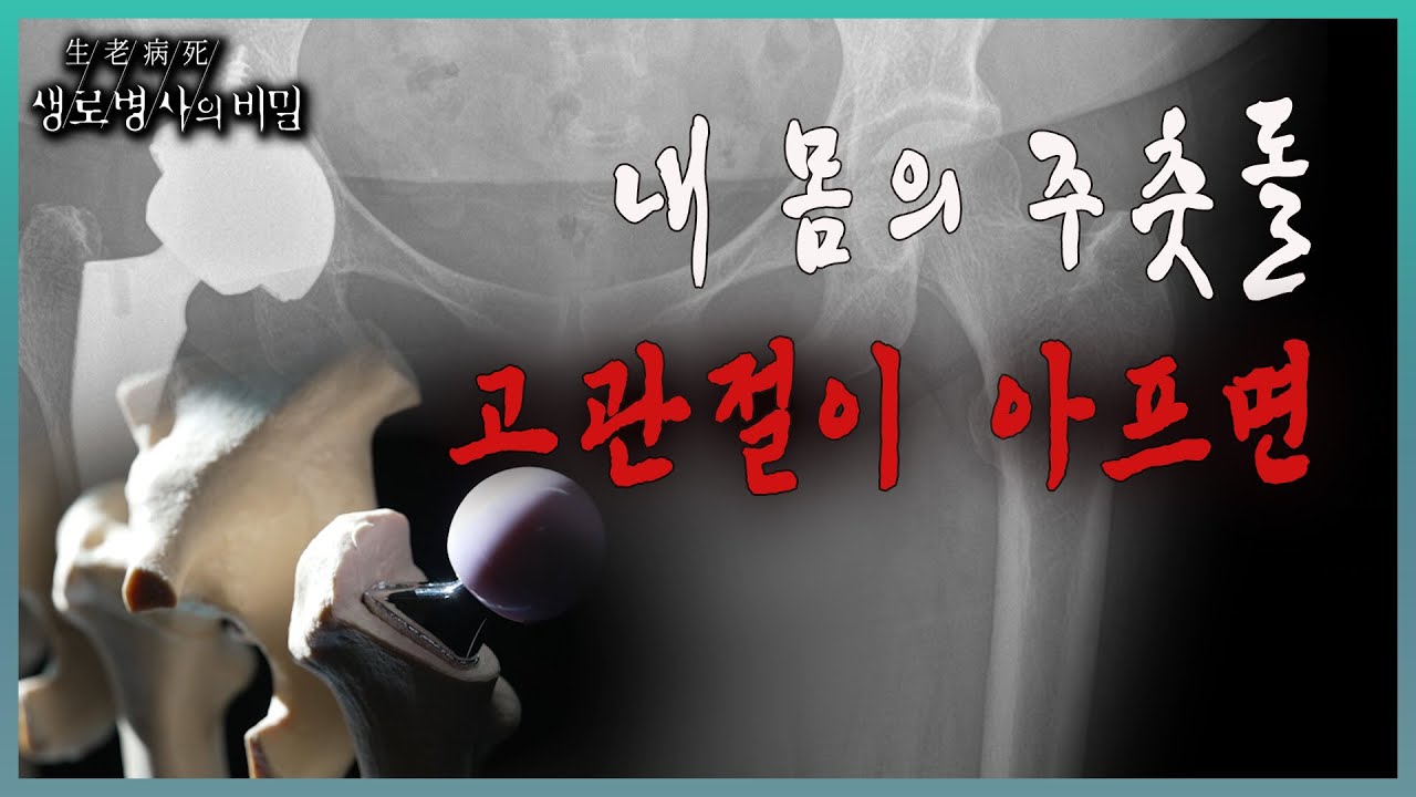 📌방송 하이라이트📌 고관절 뼈가 부러져서, 고관절에 병이 생겨서, 걷지 못하게 된 후에야 고관절의 중요성을 깨닫게 된 사람들을 만나본다 l KBS 20231115 방송