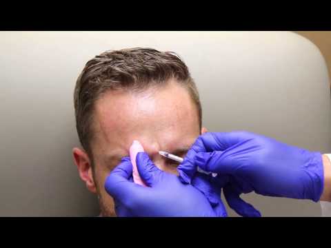 Brotox: Botox For Men