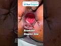 In 1 Minute Stapler Hemorrhoidectomy In Simple English Piles Surgery MIPH Operation I Mumbai