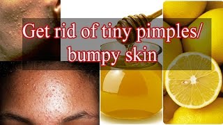 Get rid of tiny pimples / bumpy skin with this miracle face pack