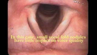 Download lagu Vocal Folds Revealed mp3