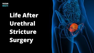 Life After Urethral Stricture Surgery