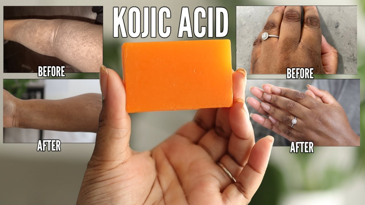 KOJIC ACID SOAP - How to lighten dark spots and get the best results