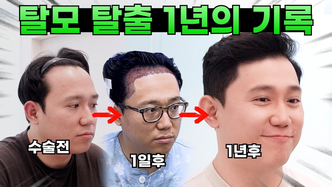 탈모 탈출 1년 기록! 모발이식의 모든 과정을 담았다!