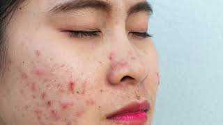 Acne Rosacea 100% Cure | How to Get Rid of Rosacea Skin Redness & Itching Naturally & Permanently