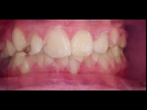 K.R. Class I crowding