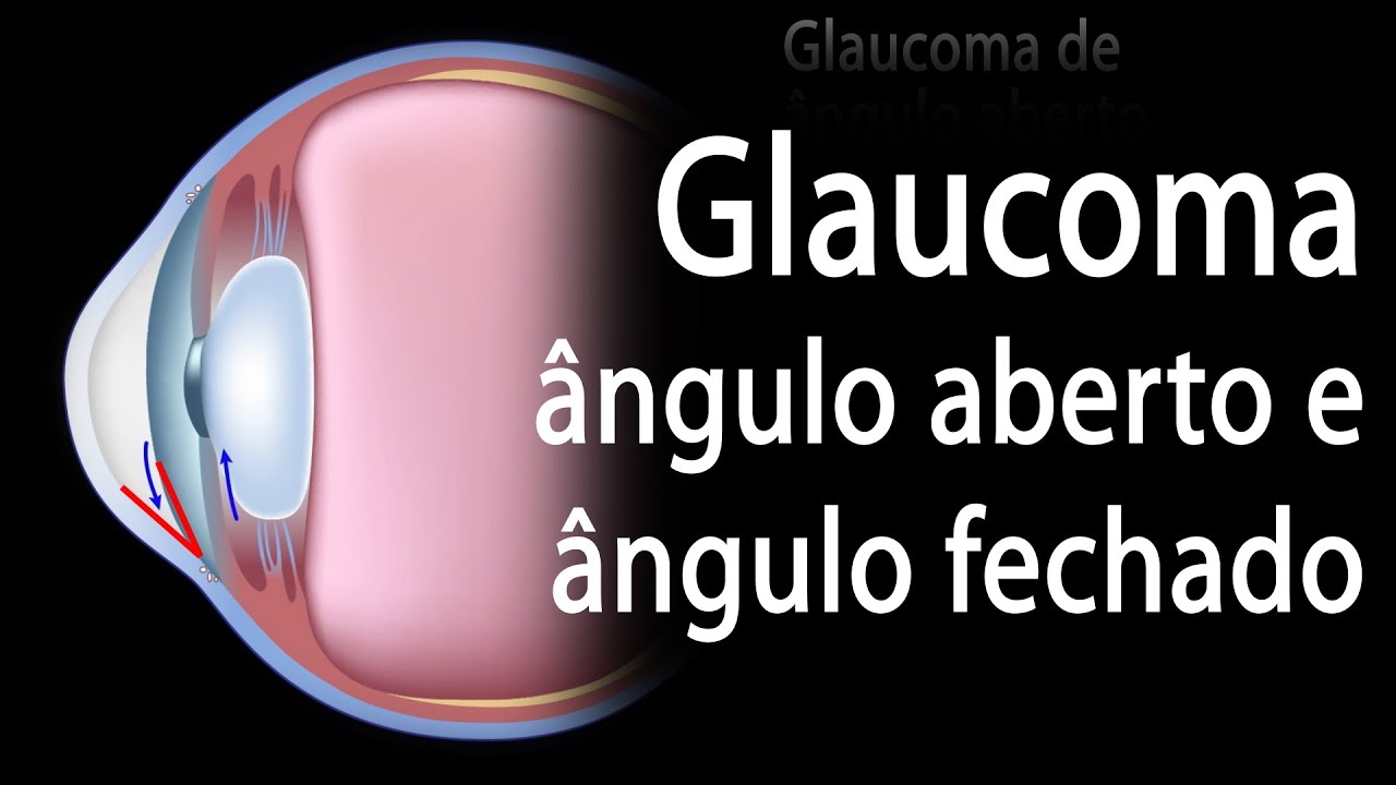 Desenvolvimento de Glaucoma, Ângulo Aberto vs Ângulo Fechado. Alila Medical Media Português.