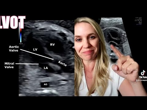 Fetal Heart Views w/ special guest Marybeth Tomory RDMS (Abd, OBGYN, FE)