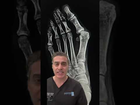 Can You Massage a Bunion Straight? Foot Doctor Responds!