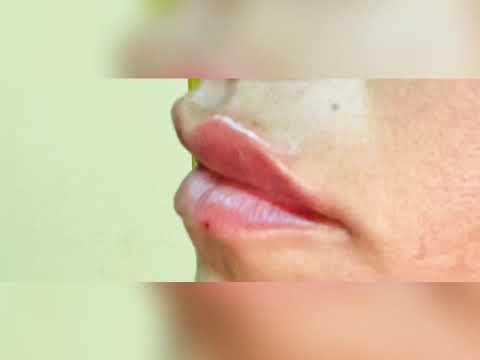 Dott. Maurizio Santoro - Trattamento Lip Contour