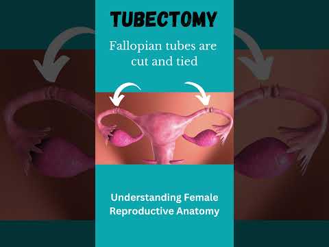 Tubectomy Procedure: A Safe Method for Permanent Contraception #fallopiantubes #shorts