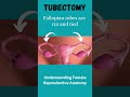 Tubectomy Procedure A Safe Method For Permanent Contraception Fallopiantubes Shorts