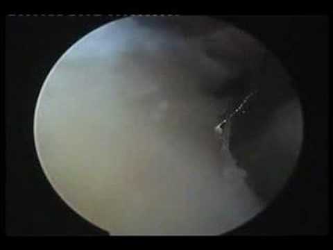 Subacromion Incision In Rotator Cuff Tear