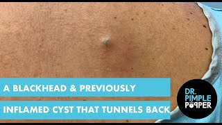 A Blackhead &amp; A Previously Inflamed Cyst that Tunnels Back