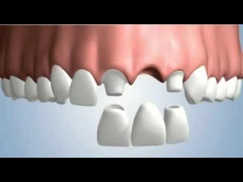 Single tooth treatment
