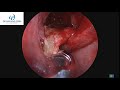THICK MUCOUS FROM YOUR NOSE OF PHLEGM