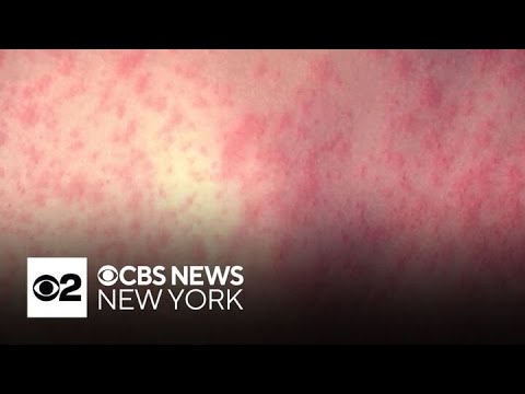 N.J. health officials warn of potential measles exposures at Newark Liberty Airport
