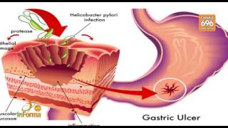 ulceri gastrointestinali dalla diagnosi alla terapia