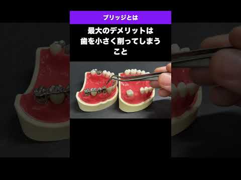 [Totsuka Ekimae Naito Dental Clinic] ① Bridge: Options after tooth extraction (back teeth) #short...