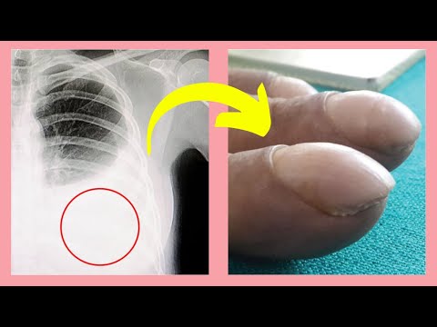 Top 10 WARNING signs of Lung Cancer