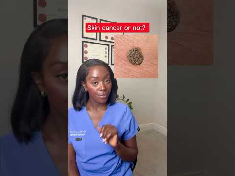 Could Your Mole Be Skin Cancer?