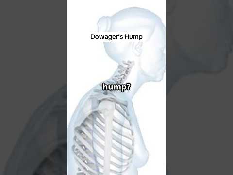 #bethesdaspineandposture #bethesdamd #chiropracticbiophysics #dowagershump #kyphosis