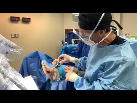 How Long Until You Can Walk Normally After a Bone Graft Surgery ASK DR MOORE