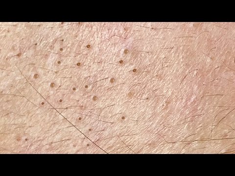Satisfying Blackhead Extractions: Watch the Gunk Get Gone!