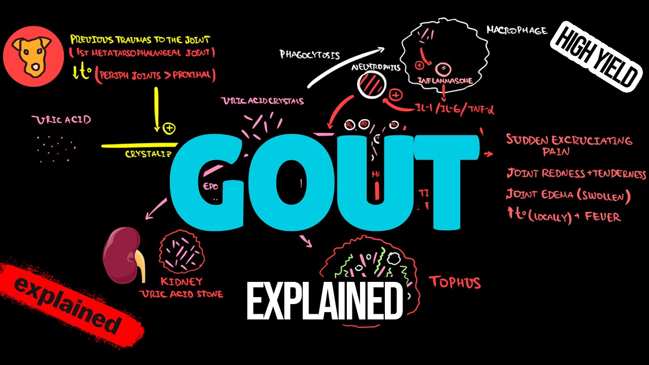 GOUT Pathogenesis  EULAR Guideline Diagnostic criteria X-ray Treatment Explained