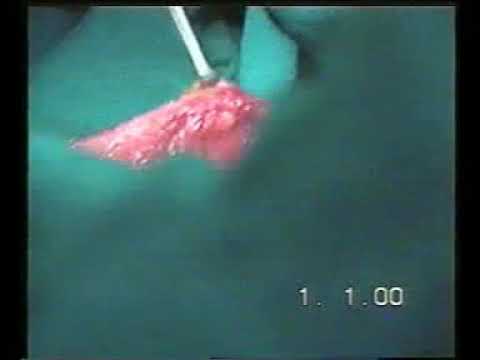 Ilioinguinal Block Dissection For SCC Sole