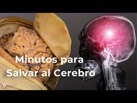 Lo que el ACV le puede hacer a tu cerebro