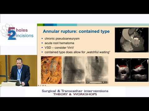 J  Kempfert  Complications in TAVI procedure