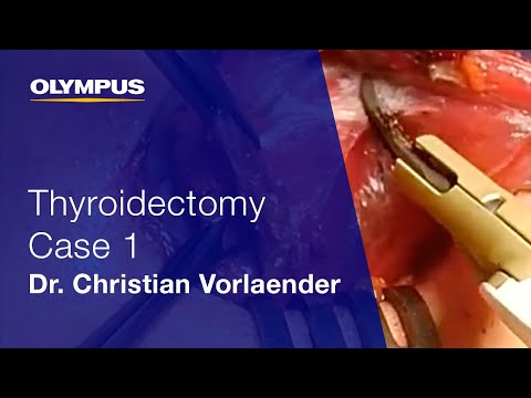 Total Thyroidectomy | THUNDERBEAT | Dr. Christian Vorlaender | Case 1